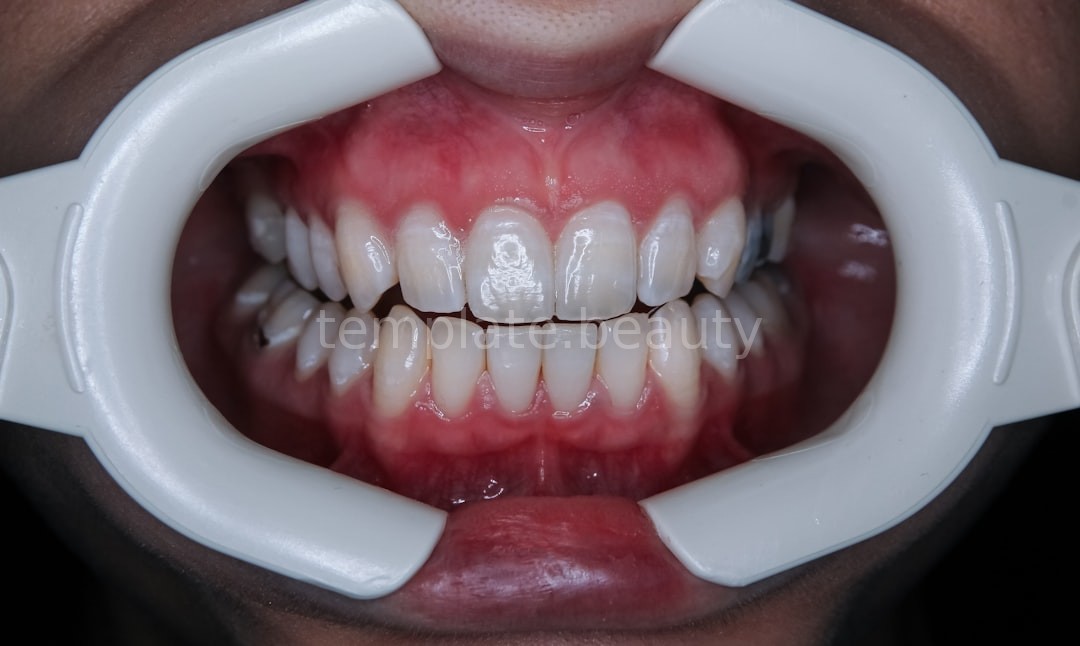 Professional Whitening